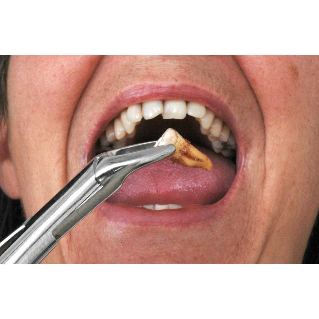 WHAT TO EXPECT AFTER WISDOM TOOTH EXTRACTION